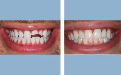 Before and After